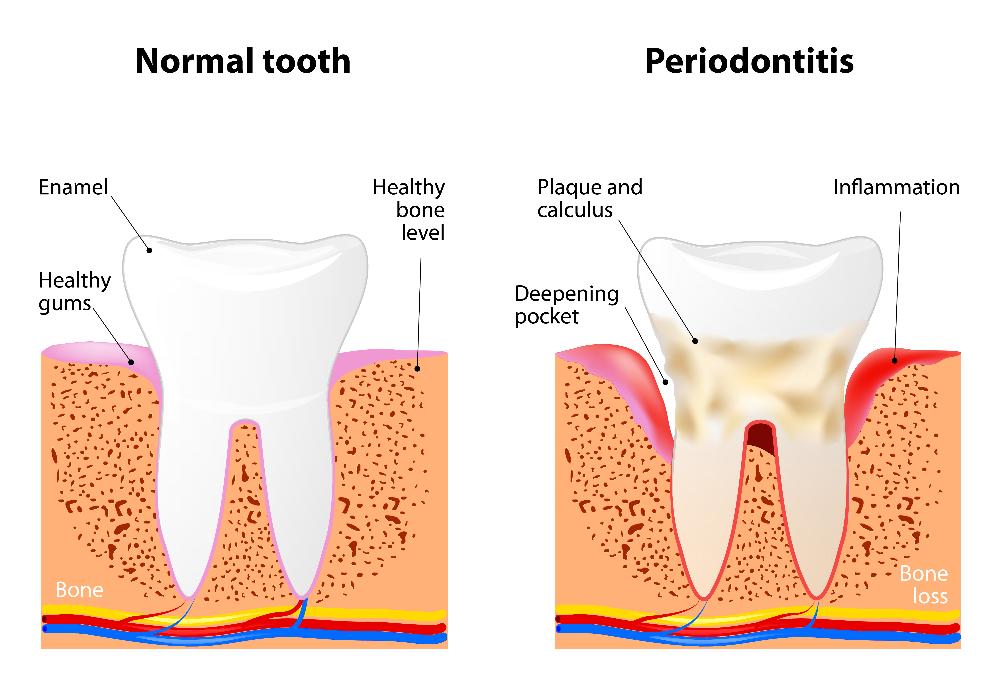 side by side gum disease teeth | dentist in los gatos