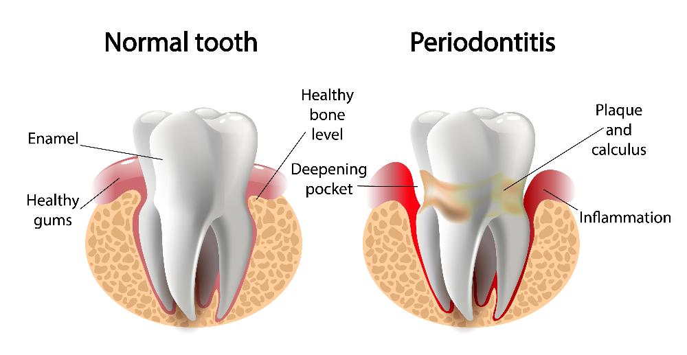 diagram of gum disease | dentist in los gatos
