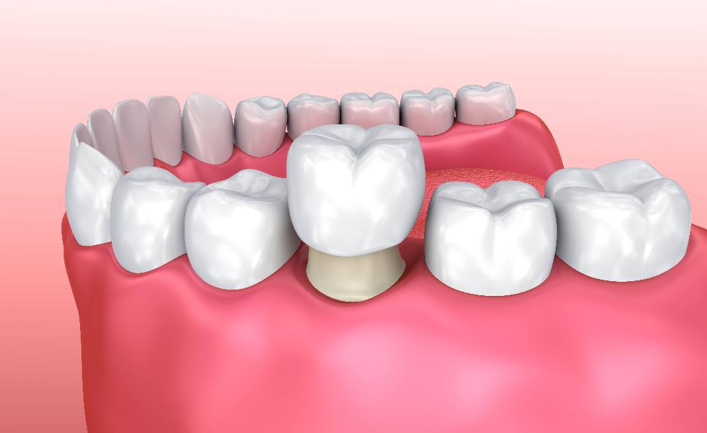 close up of dental crown | dental crowns los gatos ca