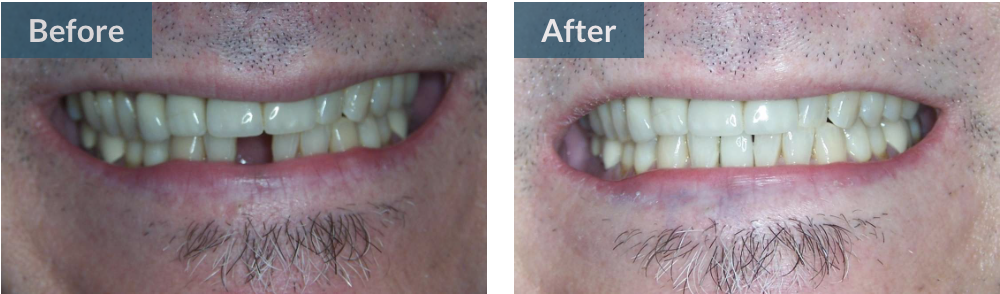 before and after gaps in smile image | dental implants los gatos ca
