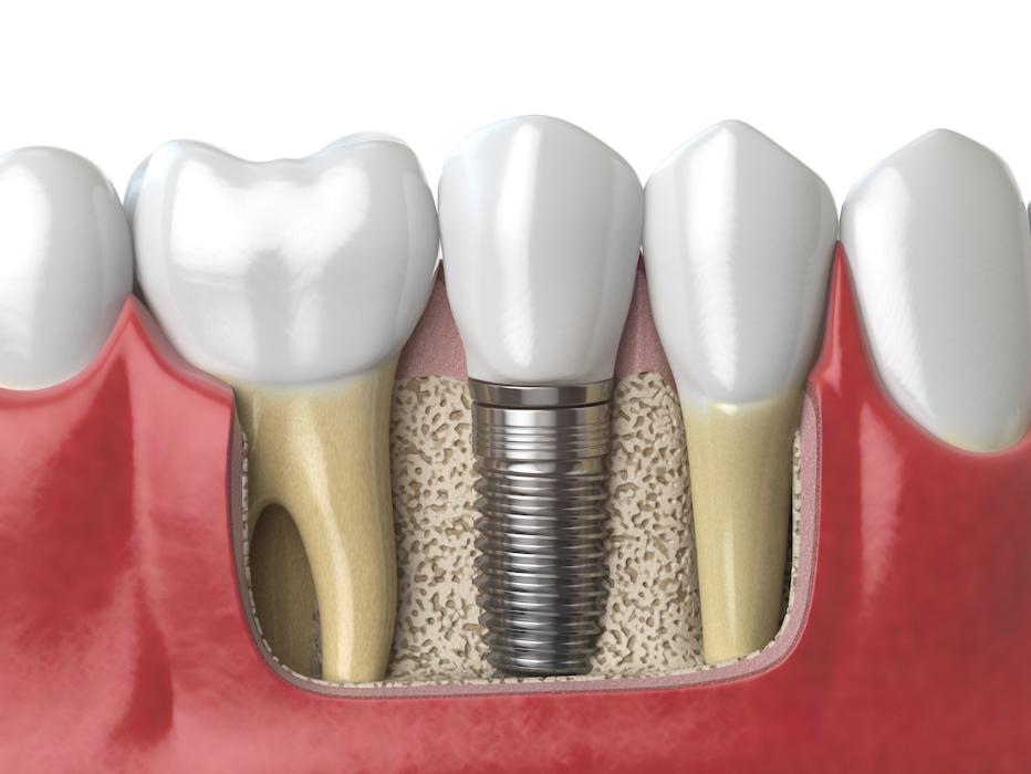 close up of dental implant in jaw | dentist los gatos ca
