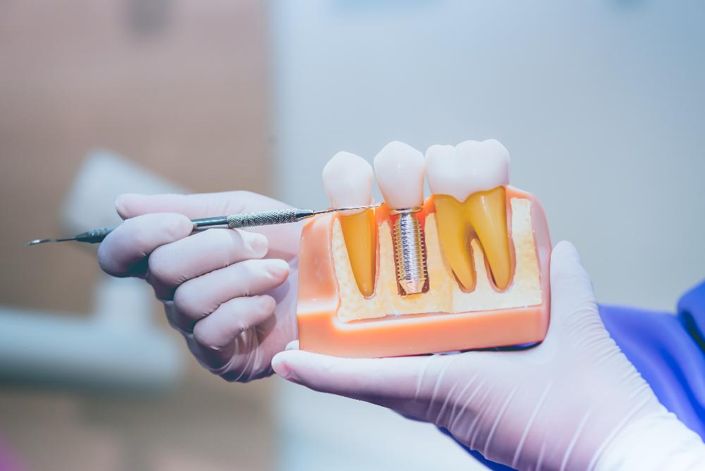 dental implant model in mouth | dental implants los gatos ca