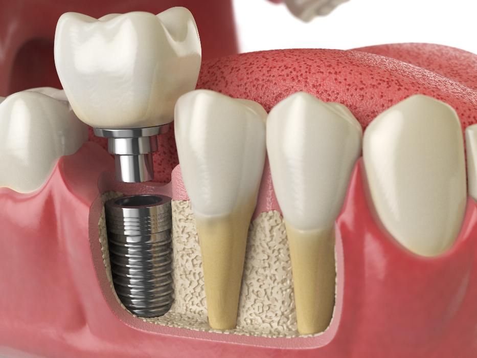 close up of dental implant in lower jaw | dental implants los gatos ca