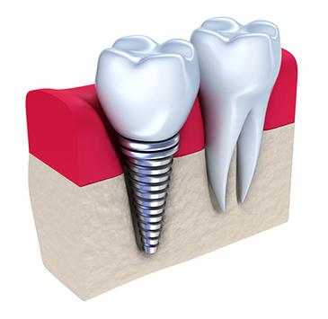 close up of dental implant | dental implants los gatos ca