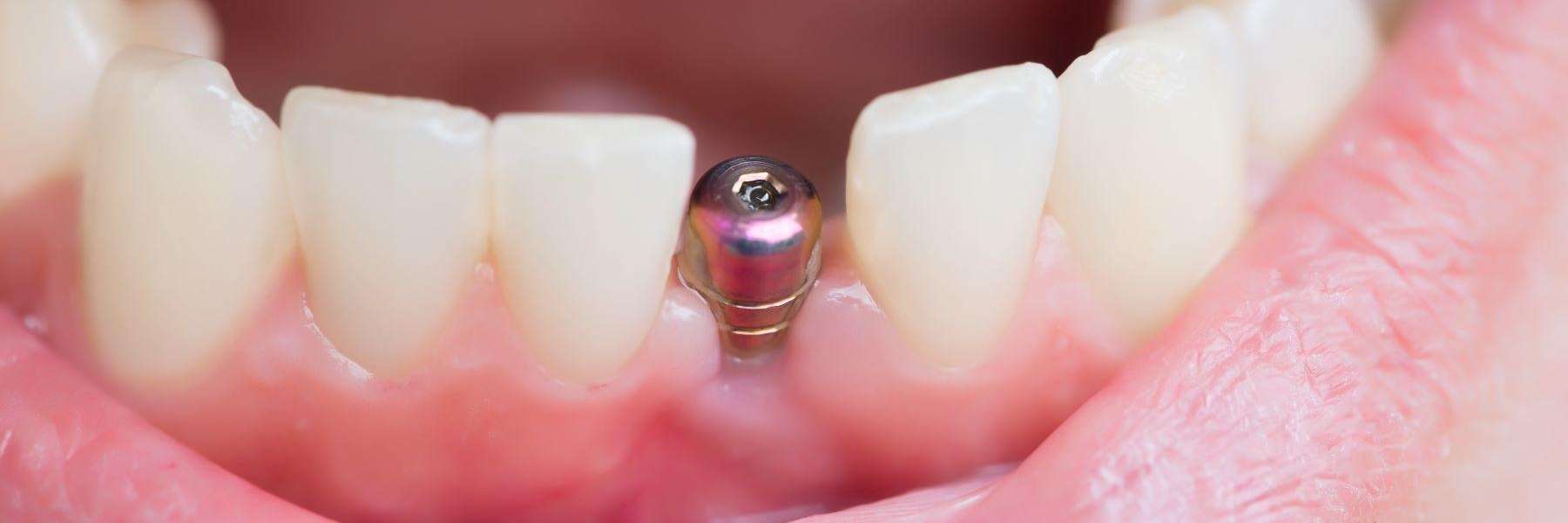 close up of one dental implant in lower jaw | los gatos ca dentist