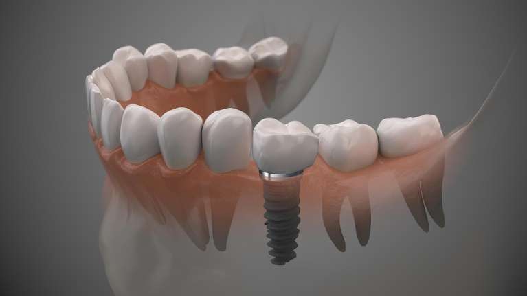 close up of dental implant mold | dental implants los gatos ca