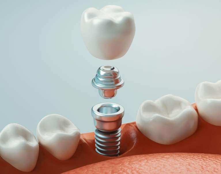 close up of dental implant in 3 pieces | los gatos dental implants