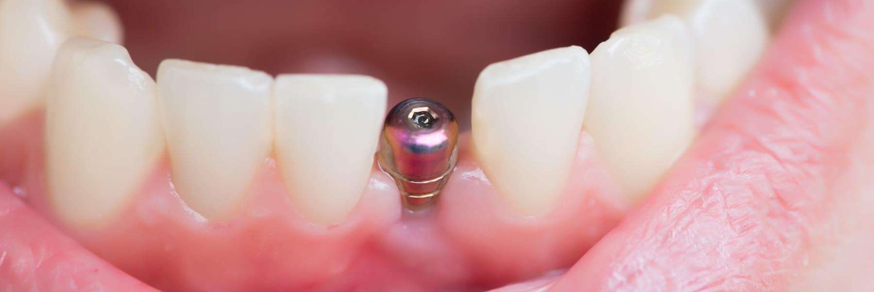Close up of a real life dental implant in los gatos ca