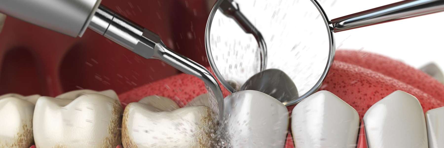Image of teeth being cleaned, los gatos ca