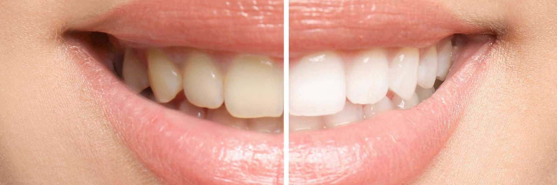 before and after teeth whitening | dentist los gatos ca