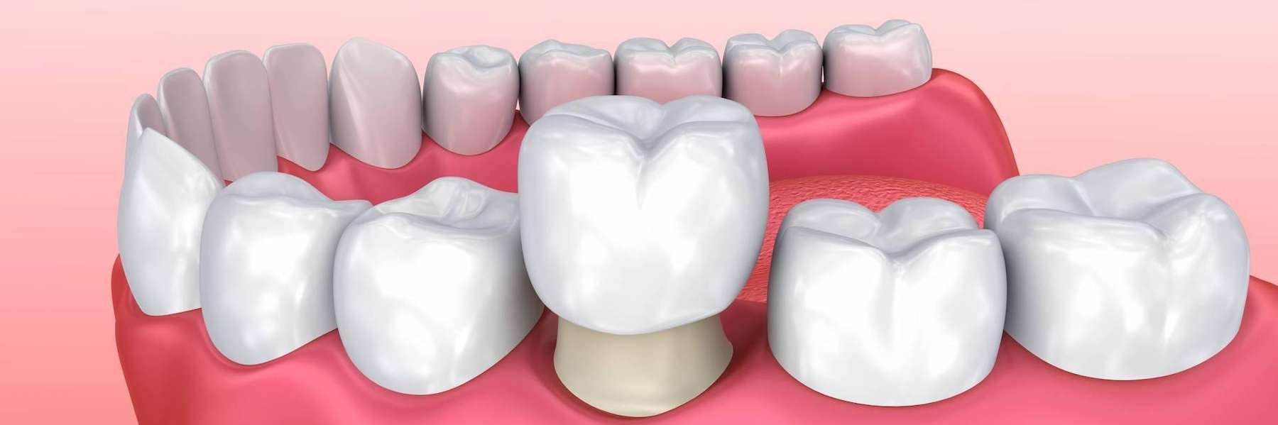 dental crown going on tooth | dentist los gatos ca