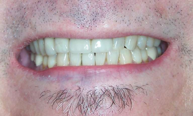 A-Dental-implant-Is-an-Excellent-Solution-for-This-Los-Gatos-Professional-After-Image