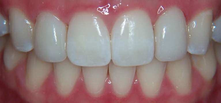 porcelain veneers in los gatos | los gatos ca dentist