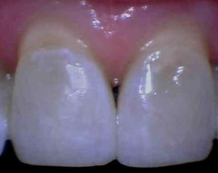 after dental treatment | dentist los gatos ca