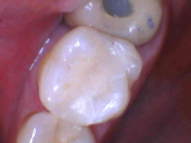 filled cavity after dental treatment | los gatos dentist