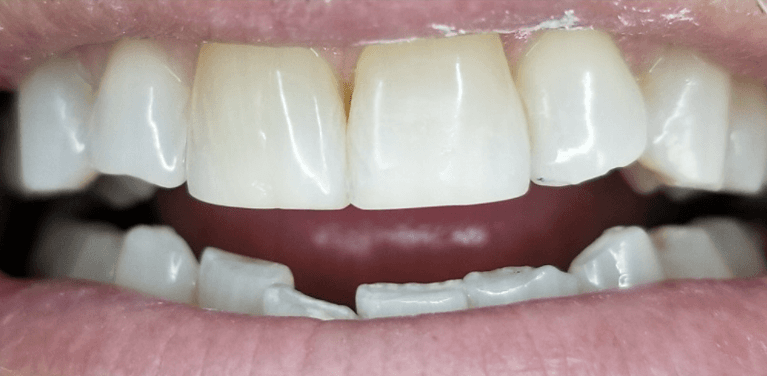 tooth colored filling to fix a chipped tooth | dentist los gatos ca