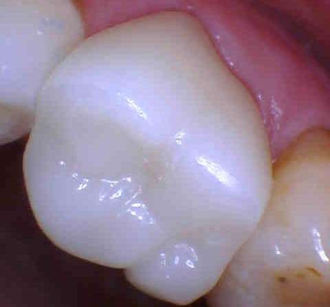 completed tooth after dentistry | dental crown los gatos ca