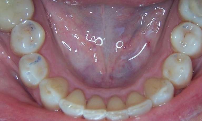 Close up of open mouth after clear aligners, los gatos ca