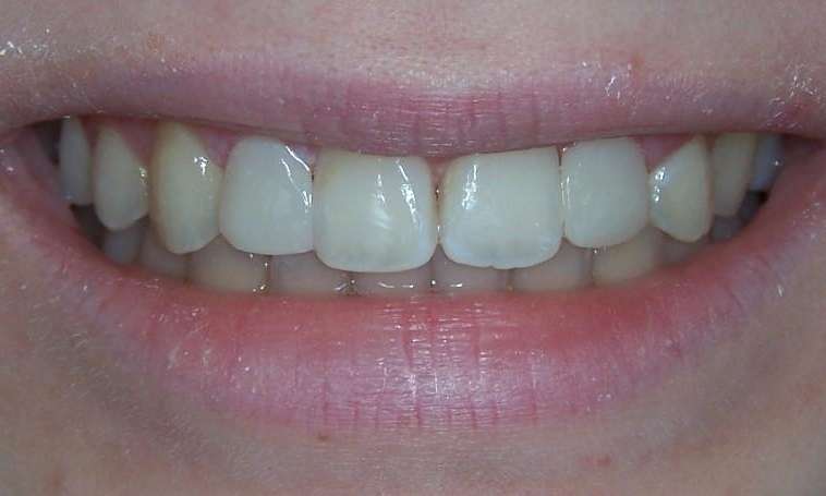 complete smile after dental treatment | dentist los gatos ca