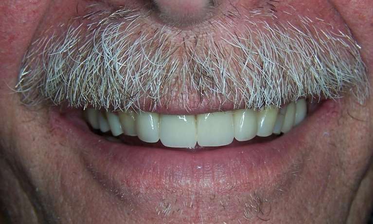 Older man with mustache close up of his mouth after crowns, los gatos ca