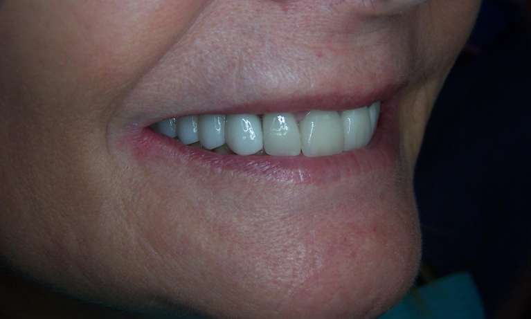 Dental-Implant-Bridge-Before-After-After-Image