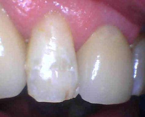 after image of cosmetic dentistry | dentist los gatos ca