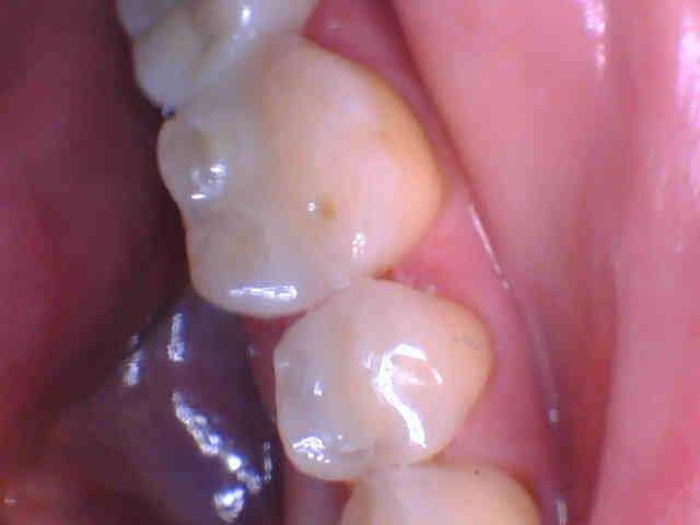 close up tooth colored fillings | los gatos ca dentist