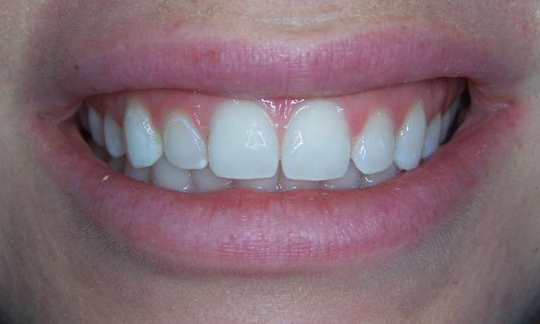 Before-After-White-Spot-Treatment-After-Image