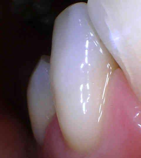 clean gums after cosmetic services | dentist in los gatos ca