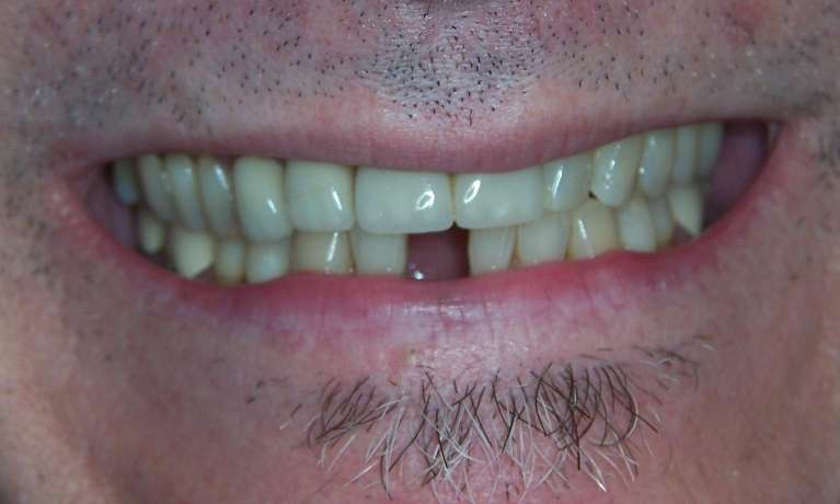 A-Dental-implant-Is-an-Excellent-Solution-for-This-Los-Gatos-Professional-Before-Image