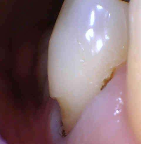 gum line before dental bonding | dental bonding los gatos ca