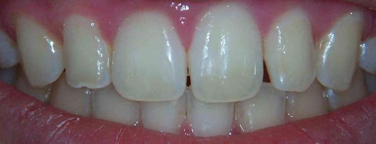 porcelain veneers in los gatos | dentist los gatos ca