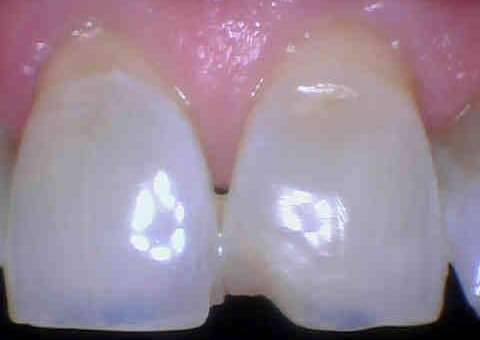 before cosmetic dentistry | cosmetic dentistry los gatos ca