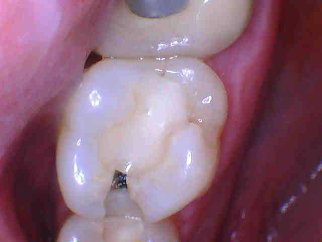 cavity before tooth filling | dental bonding los gatos ca