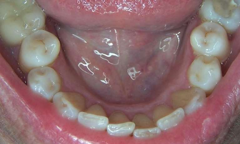 Close up of open mouth before clear aligners, los gatos ca
