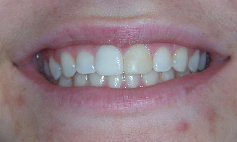 smile before porcelain veneers | dentist in los gatos ca