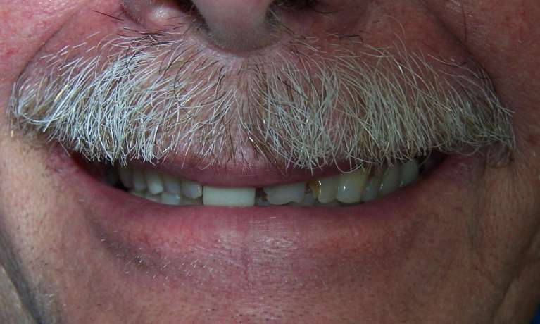 Older man with mustache close up of his mouth before crowns, los gatos ca