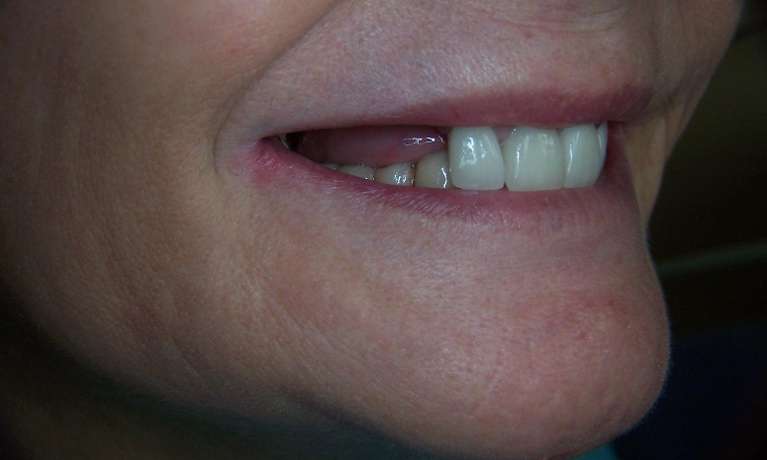 Dental-Implant-Bridge-Before-After-Before-Image