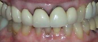 gummy smile before dental crowns | dental crowns los gatos ca