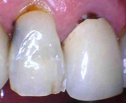 before image of tooth decay | cosmetic dentist los gatos ca