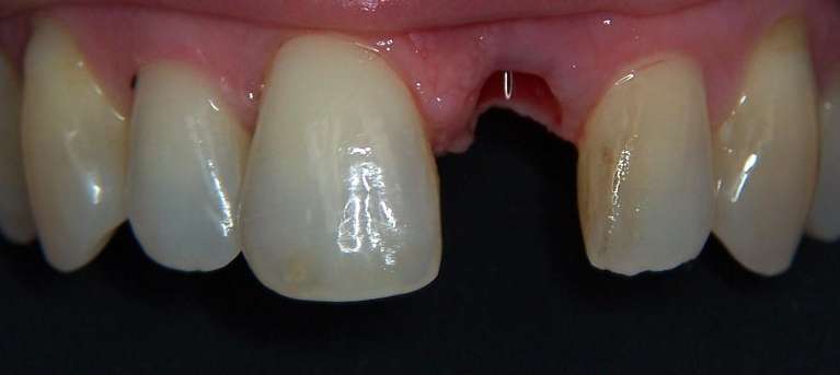 gap tooth smile before cosmetic dentistry | dentist los gatos ca