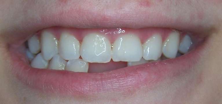 missing teeth before dental treatment | dental implants los gatos ca