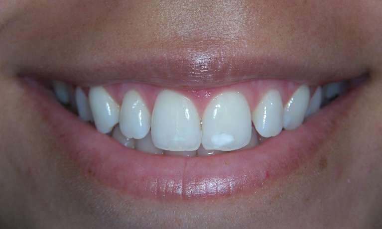 Removing-White-Spots-from-Front-Teeth-Before-Image