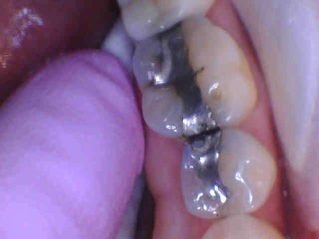 silver fillings before tooth fillings | tooth colored fillings los gatos ca