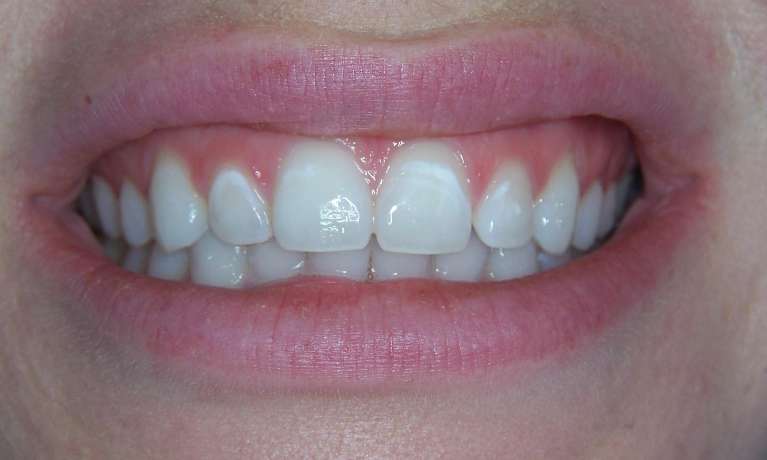 Before-After-White-Spot-Treatment-Before-Image